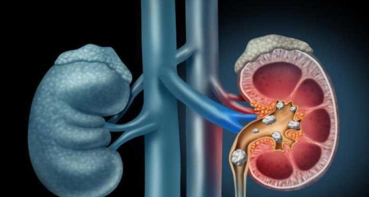 Sering Dianggap Kebiasaan Sehat Padahal 5 Hal Ini Bisa Merusak Ginjal Menurut Dokter